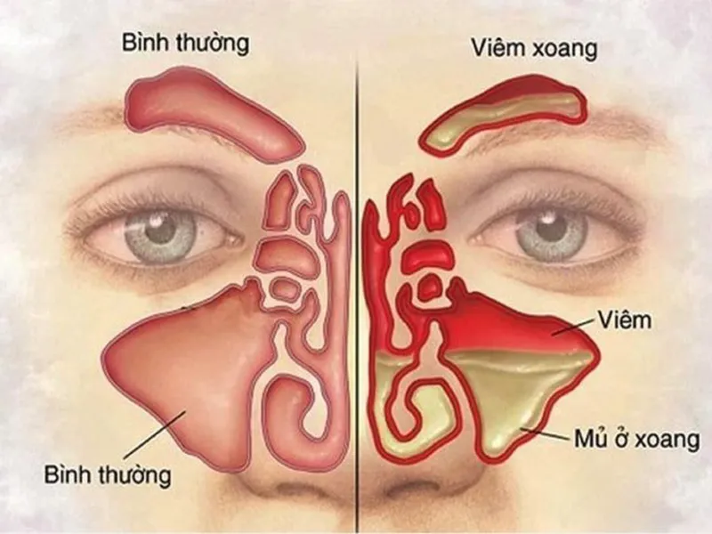 VIÊM XOANG – BỆNH DỄ TÌM MÀ KHÓ TRỊ