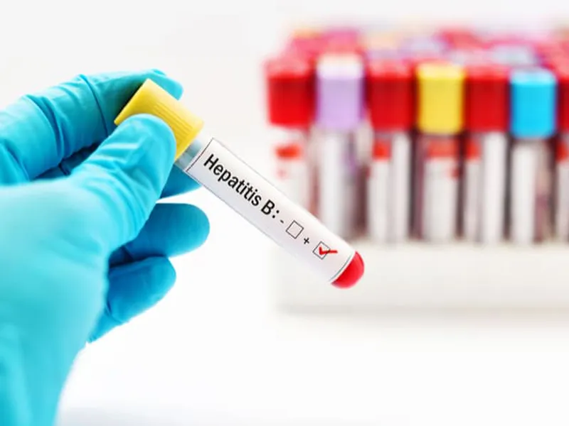 XÉT NGHIỆM VIÊM GAN SIÊU VI B BẰNG PHƯƠNG PHÁP XÉT NGHIỆM TỰ ĐỘNG HBsAg