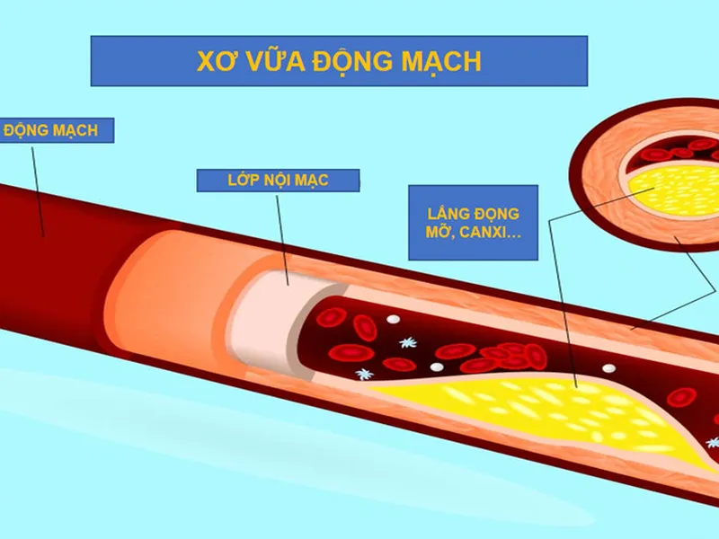 XƠ VỮA ĐỘNG MẠCH