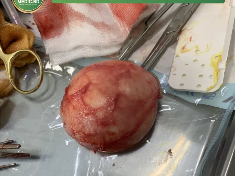 TIỂU PHẪU U BÃ ĐẬU LỚN NHẤT TỪ TRƯỚC ĐẾN NAY