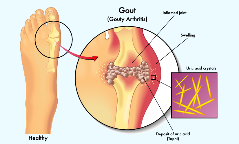 TĂNG ACID URIC MÁU: NGUYÊN NHÂN, TRIỆU CHỨNG VÀ ĐIỀU TRỊ