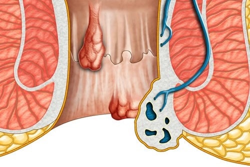 Chữa bệnh trĩ bằng tỏi Chữa bệnh trĩ bằng tỏi