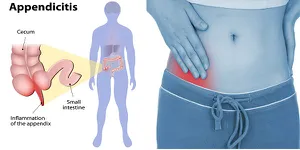 Tỏi đen và ung thư dạ dày