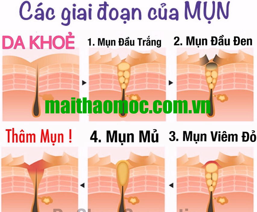 Giai đoạn phát triển mụn Giai đoạn phát triển mụn