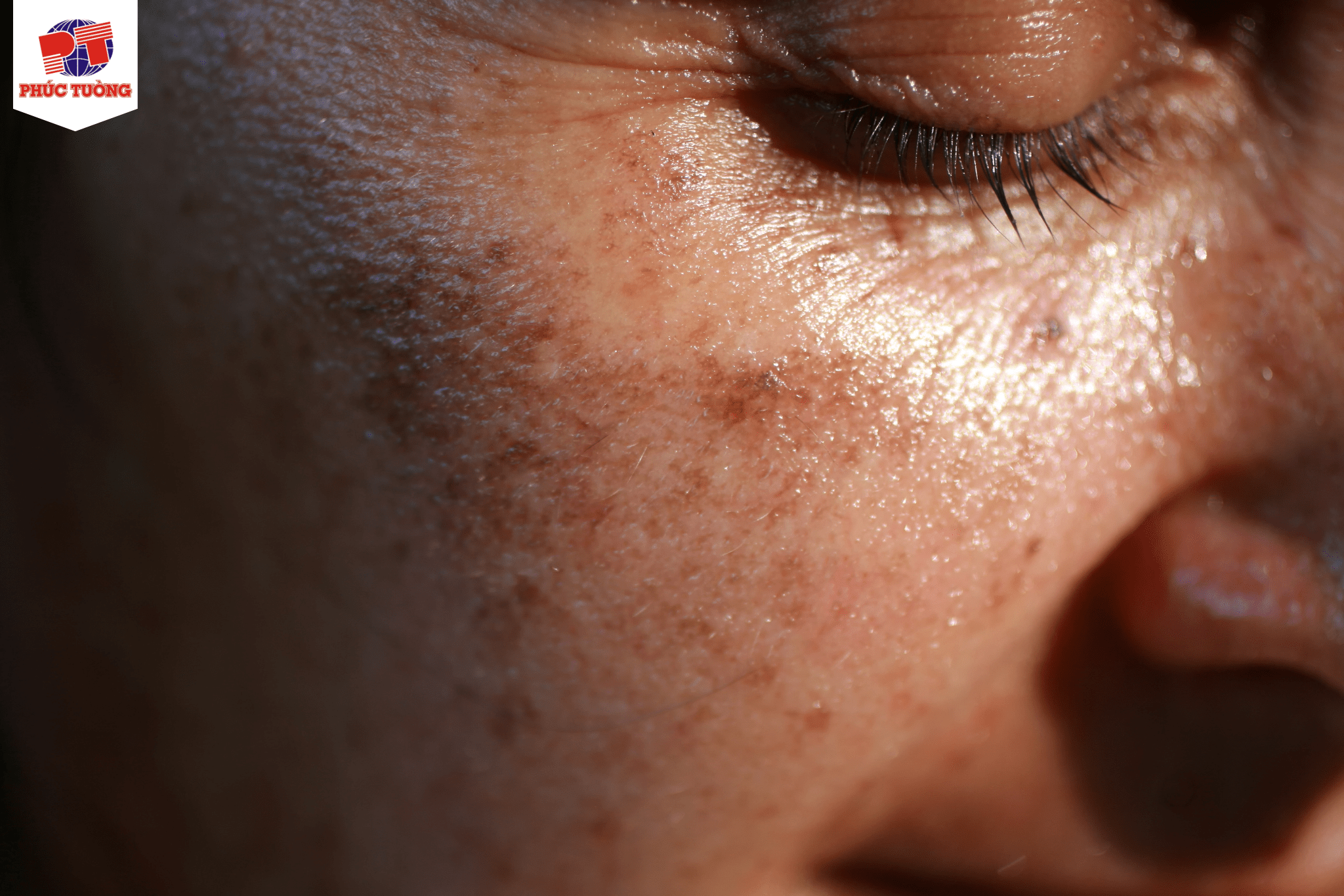 Biểu hiện da của người bệnh tiểu đường Biểu hiện da của người bệnh tiểu đường