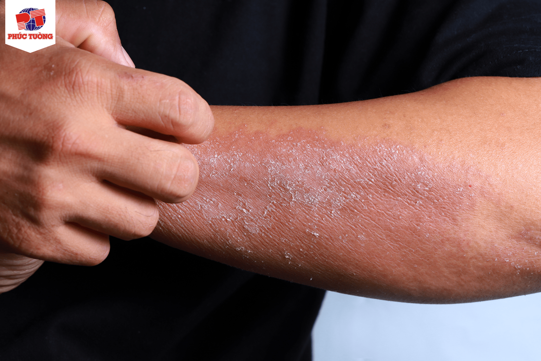 Biểu hiện da của người bệnh tiểu đường Biểu hiện da của người bệnh tiểu đường