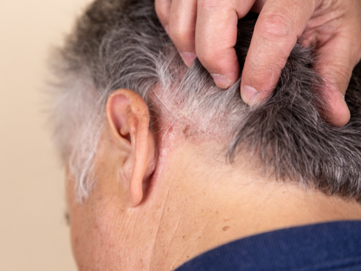 Bệnh chàm thường gặp ở đối tượng nào Bệnh chàm thường gặp ở đối tượng nào