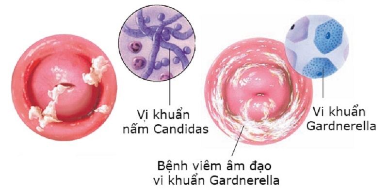 CÁC LOẠI BỆNH PHỤ KHOA THƯỜNG GẶP HIỆN NAY Ở NỮ GIỚI CÁC LOẠI BỆNH PHỤ KHOA THƯỜNG GẶP HIỆN NAY Ở NỮ GIỚI