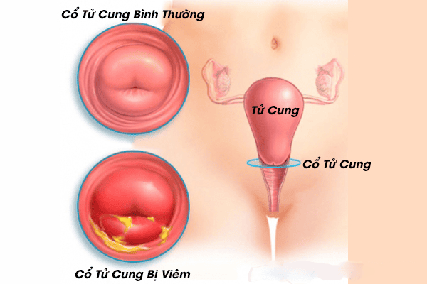 CÁC LOẠI BỆNH PHỤ KHOA THƯỜNG GẶP HIỆN NAY Ở NỮ GIỚI 2 CÁC LOẠI BỆNH PHỤ KHOA THƯỜNG GẶP HIỆN NAY Ở NỮ GIỚI 2