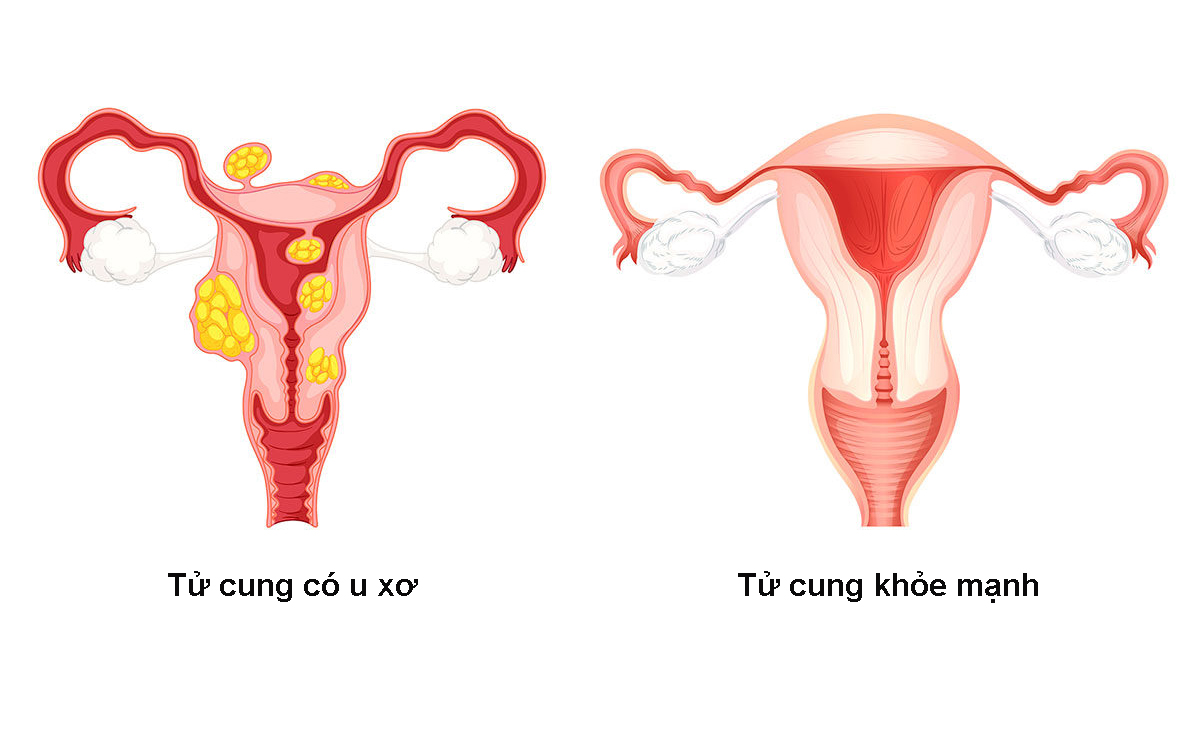 CÁC LOẠI BỆNH PHỤ KHOA THƯỜNG GẶP HIỆN NAY Ở NỮ GIỚI 4 CÁC LOẠI BỆNH PHỤ KHOA THƯỜNG GẶP HIỆN NAY Ở NỮ GIỚI 4