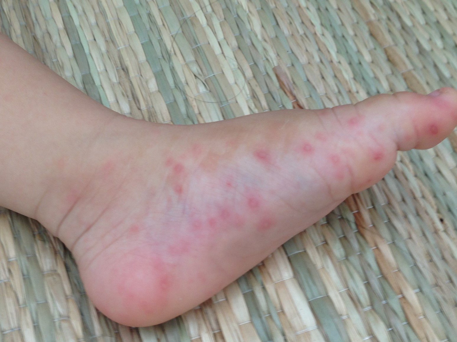 Triệu chứng của sốt xuất huyết Triệu chứng của sốt xuất huyết