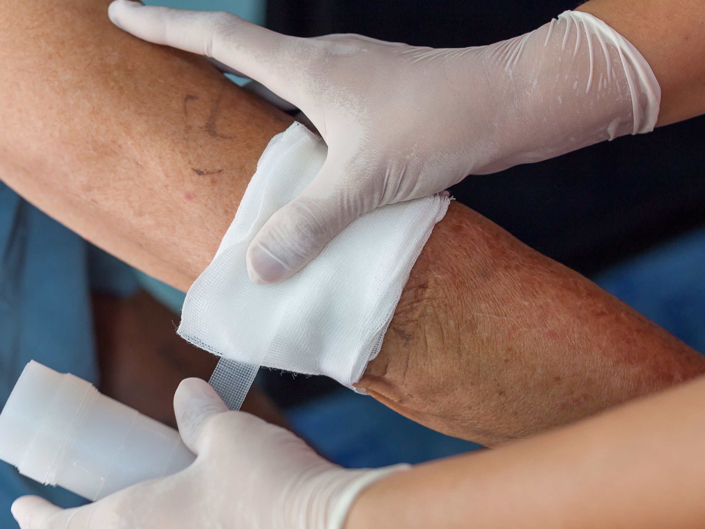 Các loài vi khuẩn gây nên căn bệnh này xâm nhập vào cơ thể thông qua các vùng da bị phá vỡ tính nguyên vẹn Các loài vi khuẩn gây nên căn bệnh này xâm nhập vào cơ thể thông qua các vùng da bị phá vỡ tính nguyên vẹn