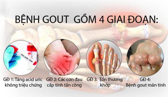 Các Giai Đoạn Của Bệnh Gout: Nguyên Nhân, Triệu Chứng và Phương Pháp Điều Trị Hiệu Quả