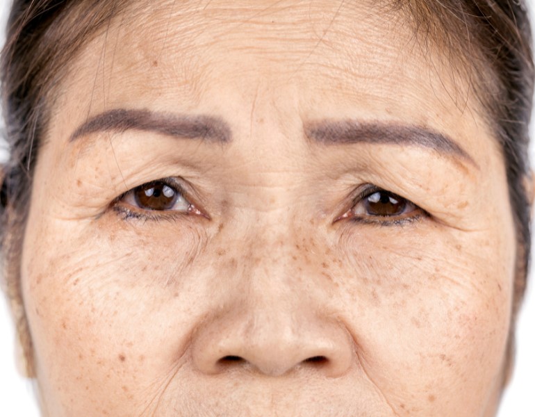 Thiếu ngủ sẽ làm chậm quá trình phục hồi da, khiến da trở nên nhăn nheo Thiếu ngủ sẽ làm chậm quá trình phục hồi da, khiến da trở nên nhăn nheo