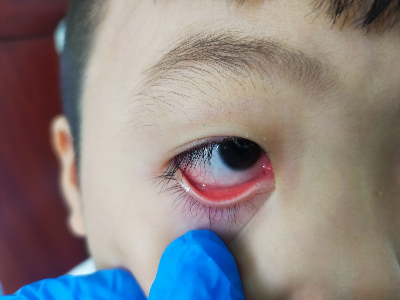 Dấu hiệu nhận biết bệnh đau mắt đỏ Dấu hiệu nhận biết bệnh đau mắt đỏ