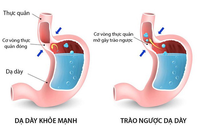 Trào ngược dạ dày (GERD) Trào ngược dạ dày (GERD)