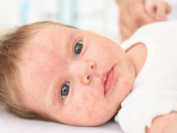 Nguyên nhân dẫn đến trẻ bị bệnh chàm Nguyên nhân dẫn đến trẻ bị bệnh chàm