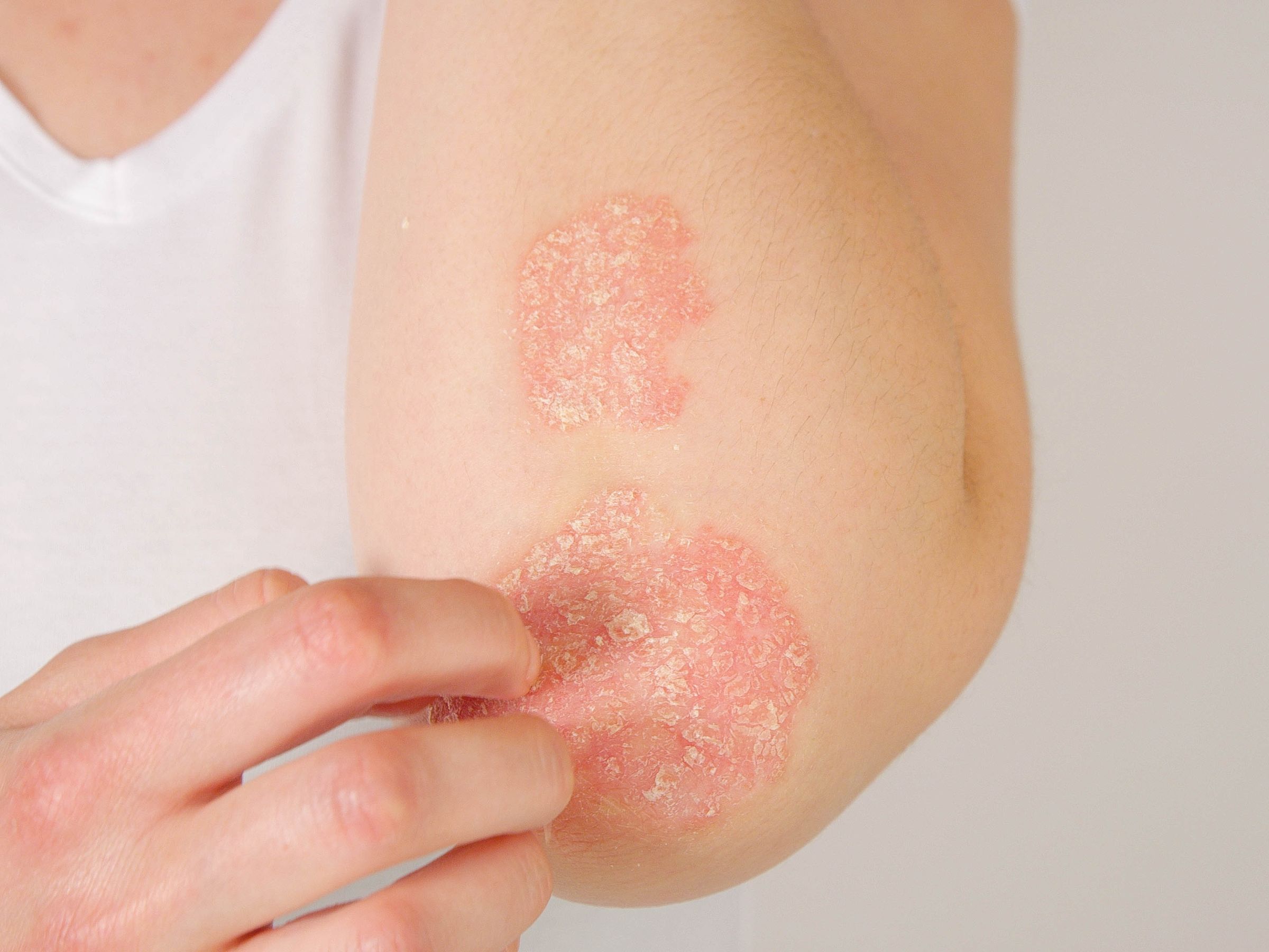 Bệnh chàm được đặc trưng bởi sự viêm nhiễm và gây ngứa, khó chịu cho người bệnh Bệnh chàm được đặc trưng bởi sự viêm nhiễm và gây ngứa, khó chịu cho người bệnh