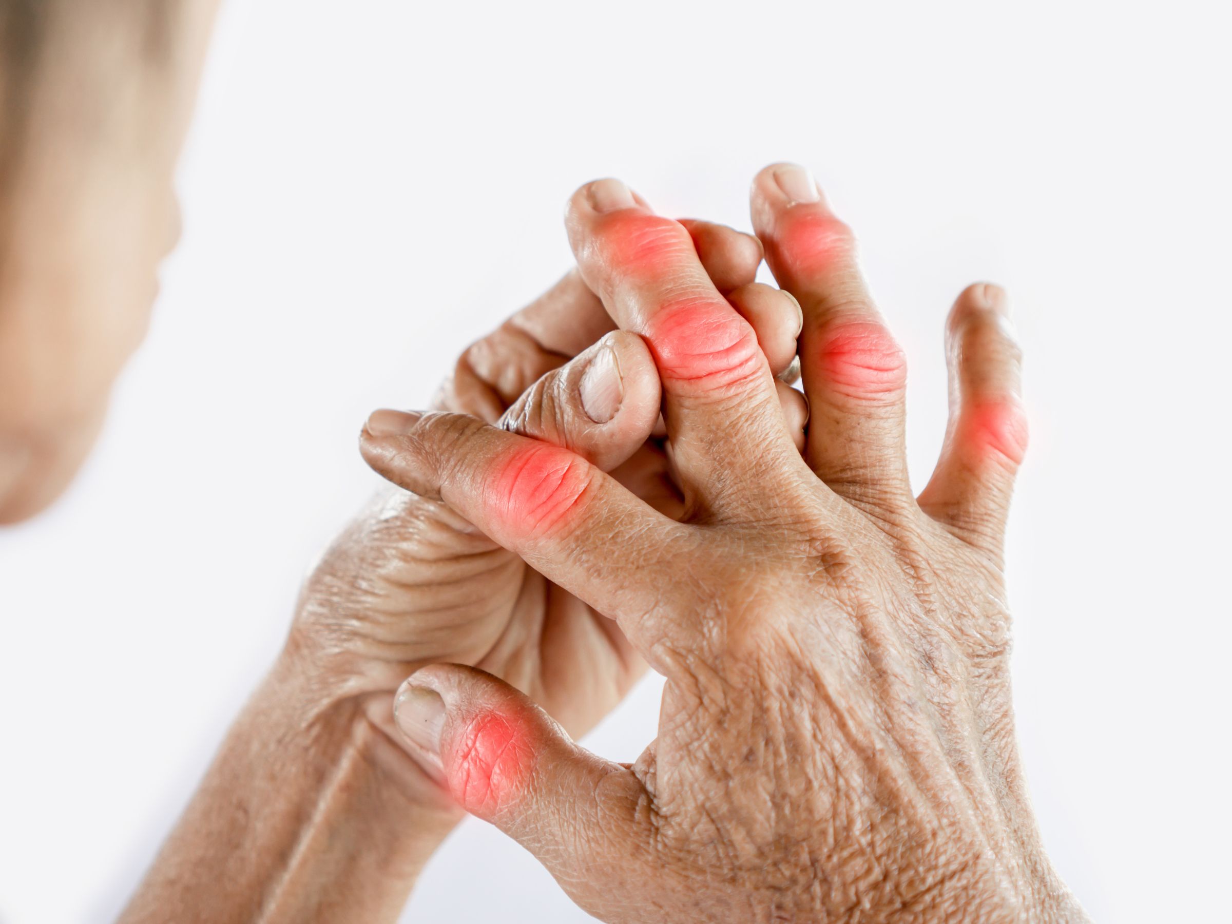 Xuất hiện các hạt tophi dưới da Xuất hiện các hạt tophi dưới da