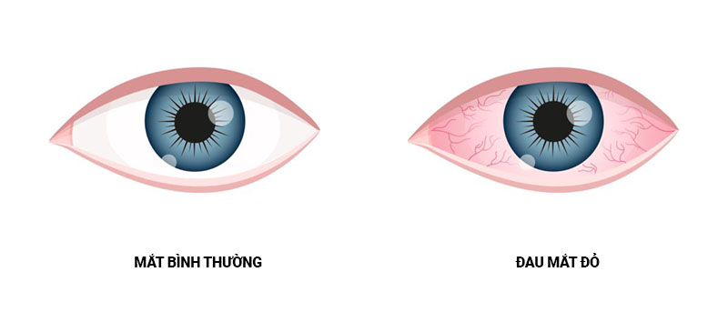 Những yếu tố nguy cơ của bệnh đau mắt đỏ Những yếu tố nguy cơ của bệnh đau mắt đỏ