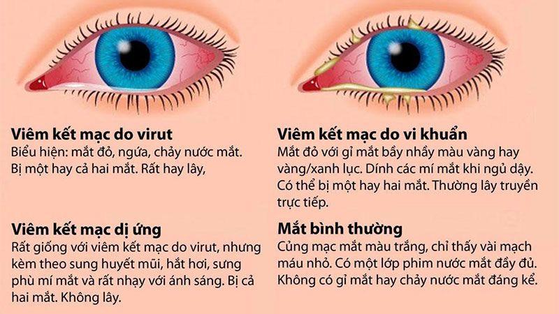 Phân biệt đau mắt đỏ với các bệnh về mắt Phân biệt đau mắt đỏ với các bệnh về mắt