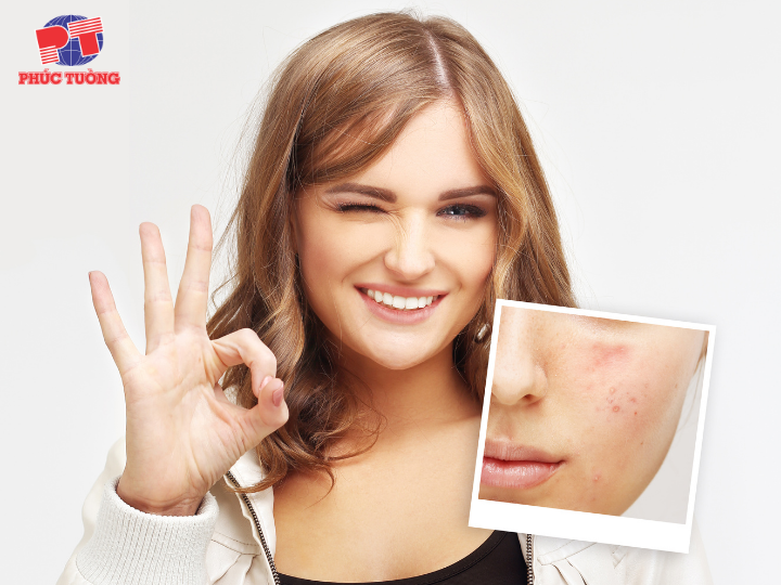 Điều trị mụn sớm có thể ngăn ngừa sẹo mụn Điều trị mụn sớm có thể ngăn ngừa sẹo mụn