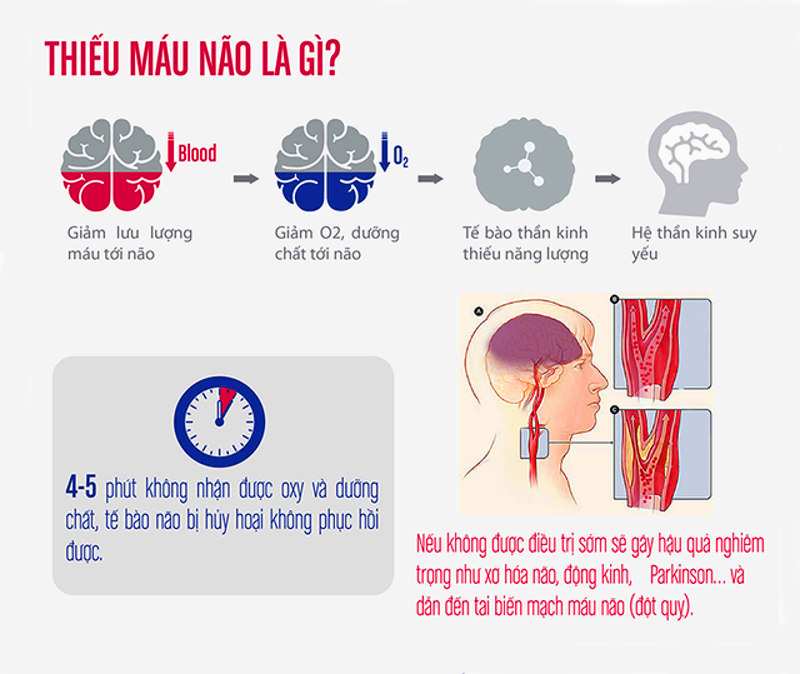 Thiếu máu não là gì? Thiếu máu não là gì?