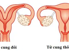 TỬ CUNG ĐÔI LÀ NHƯ THẾ NÀO?