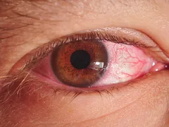 BỆNH ĐAU MẮT ĐỎ LÂY QUA ĐƯỜNG NÀO VÀ CÁCH ĐỂ PHÒNG TRÁNH?