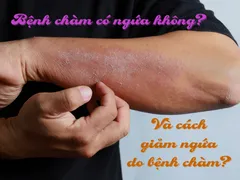 BỊ BỆNH CHÀM CÓ NGỨA KHÔNG? LÀM SAO ĐỂ GIẢM CƠN NGỨA DO BỆNH CHÀM?