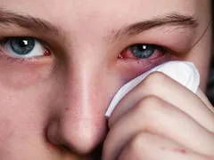 DẤU HIỆU NHẬN BIẾT BỆNH ĐAU MẮT ĐỎ