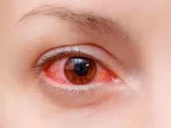 CÁC BIẾN CHỨNG NGUY HIỂM CỦA ĐAU MẮT ĐỎ