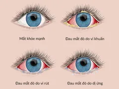 PHÂN BIỆT ĐAU MẮT ĐỎ VỚI CÁC BỆNH VỀ MẮT KHÁC