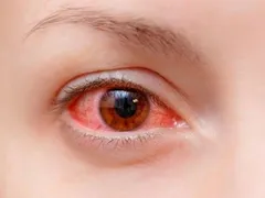NHỮNG YẾU TỐ NGUY CƠ CỦA BỆNH ĐAU MẮT ĐỎ