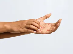 PHÂN BIỆT CÁC LOẠI BỆNH CHÀM