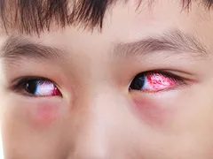 SỬ DỤNG THUỐC AN TOÀN VÀ HIỆU QUẢ ĐỂ ĐIỀU TRỊ ĐAU MẮT ĐỎ