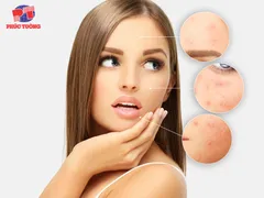 TÁC DỤNG ĐIỀU TRỊ MỤN CỦA L-CYSTINE