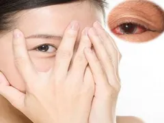TẦM QUAN TRỌNG CỦA CHẾ ĐỘ ĂN UỐNG VÀ LỐI SỐNG LÀNH MẠNH ĐỐI VỚI BỆNH ĐAU MẮT ĐỎ