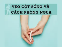 VẸO CỘT SỐNG VÀ CÁCH PHÒNG NGỪA