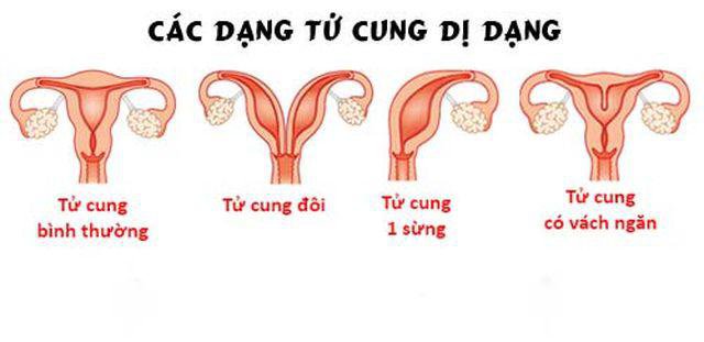 Các dạng tử cung dị dạng Các dạng tử cung dị dạng