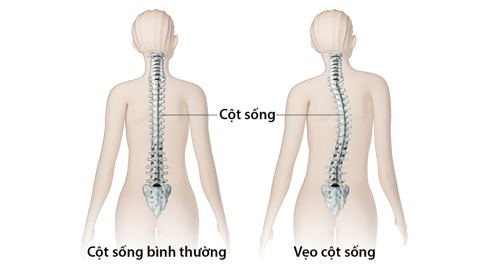 Vẹo cột sống ảnh hưởng đến dáng đi Vẹo cột sống ảnh hưởng đến dáng đi