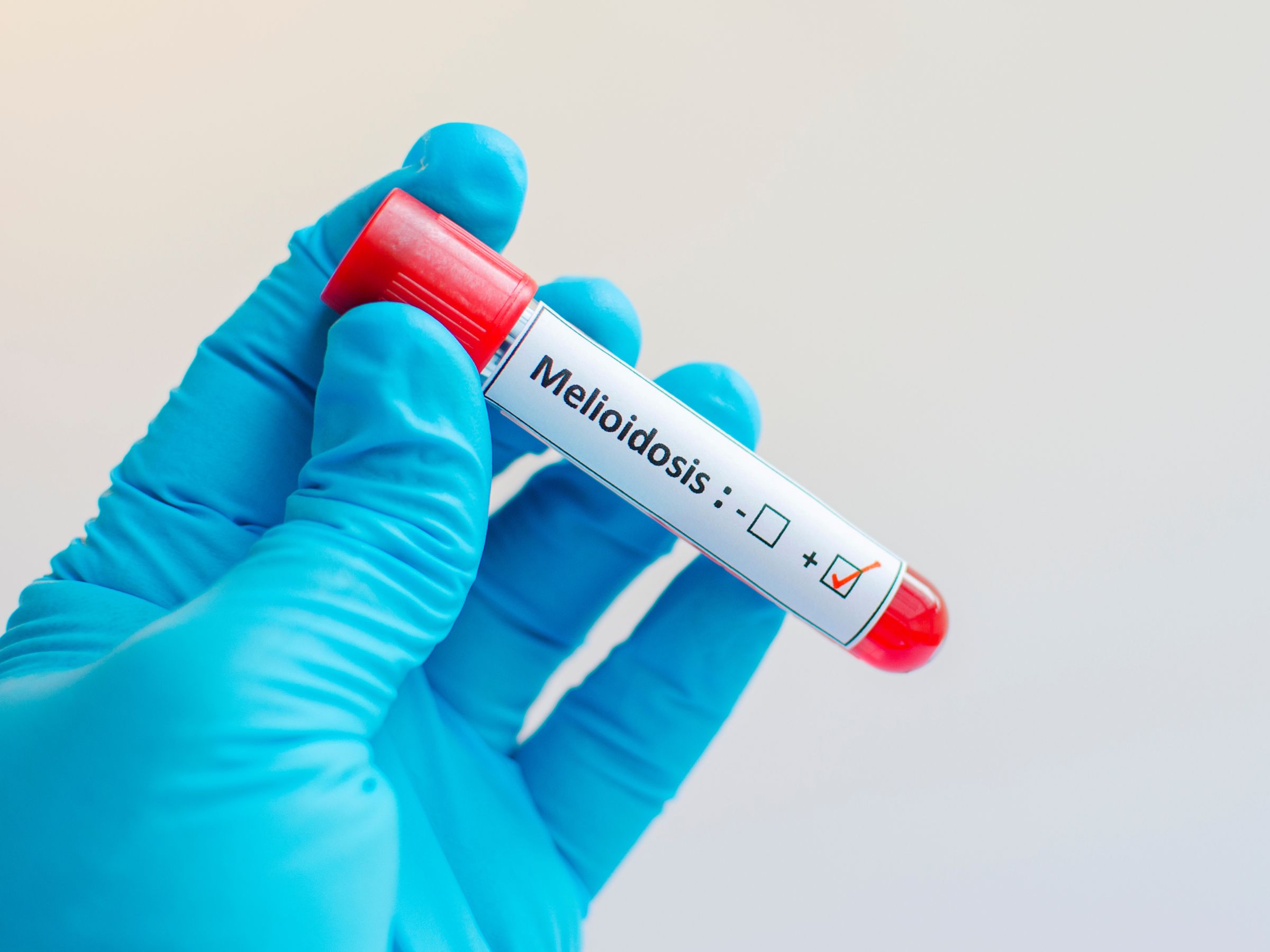 Vi khuẩn ăn thịt người hoàn toàn không có khả năng "ăn thịt người" đáng sợ như tên gọi Vi khuẩn ăn thịt người hoàn toàn không có khả năng "ăn thịt người" đáng sợ như tên gọi