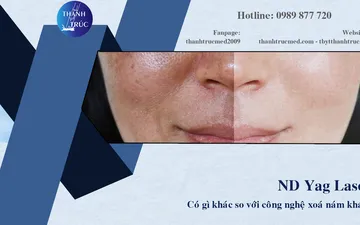 ND YAG Laser Có Gì Khác So Với Các Công Nghệ Xóa Nám Khác?
