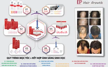 Điều trị mọc tóc như thế nào