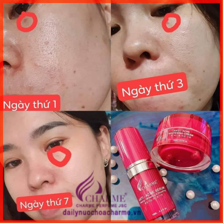 Bộ Combo Kem Trị Mụn Charme Và Serum Trị Mụn Charme Thông Đỏ