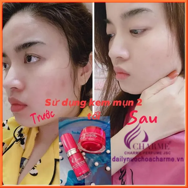 Bộ Trị Mụn Charme Thông Đỏ Hàn Quốc