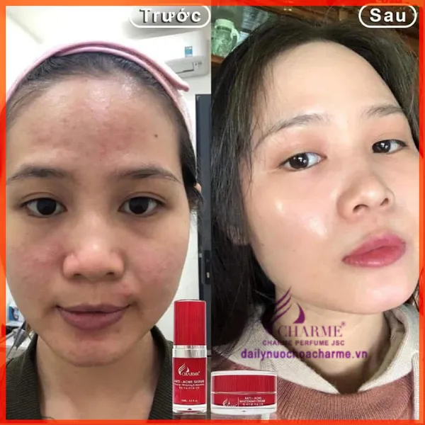 Bộ Trị Mụn Charme Thông Đỏ Hàn Quốc