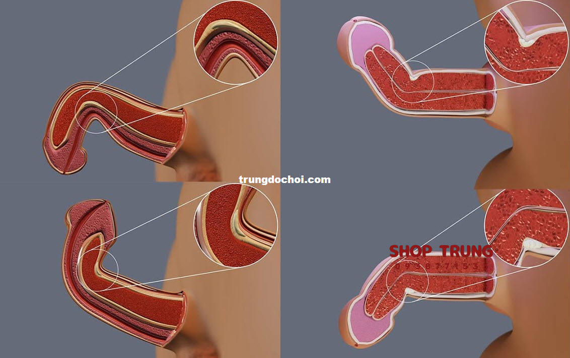 nguyen nhan duong vat bi cong nguyen nhan duong vat bi cong
