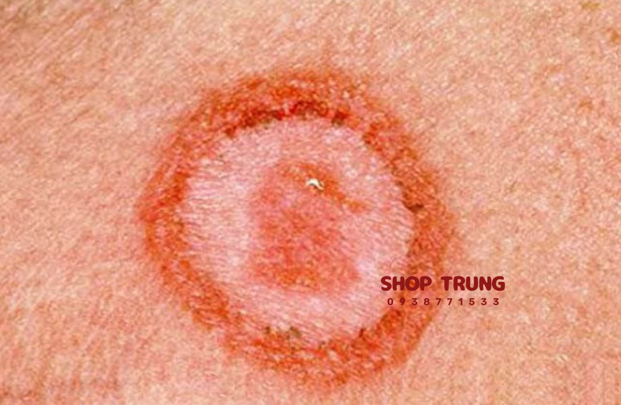 benh lay quan duong tinh duc benh lay quan duong tinh duc