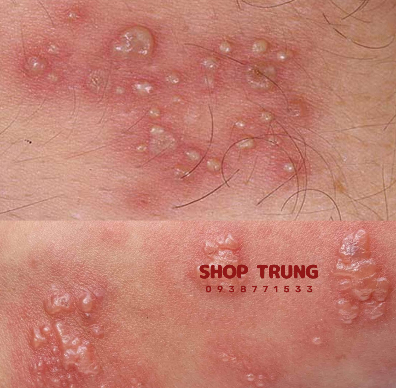 benh lay quan duong tinh duc benh lay quan duong tinh duc